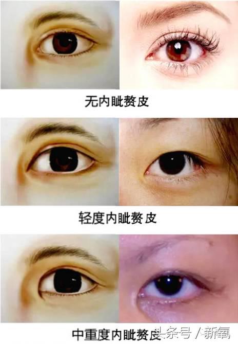 为什么开眼角会变漂亮,为什么开眼角很奇怪