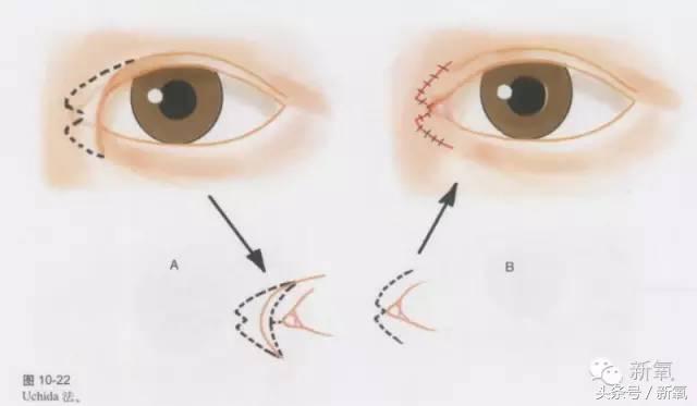 为什么开眼角会变漂亮,为什么开眼角很奇怪