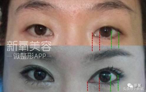 为什么开眼角会变漂亮,为什么开眼角很奇怪