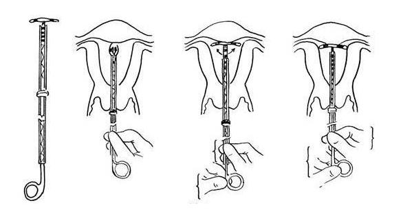 节育环取出关注些什么,女性节育环取环前关注事项