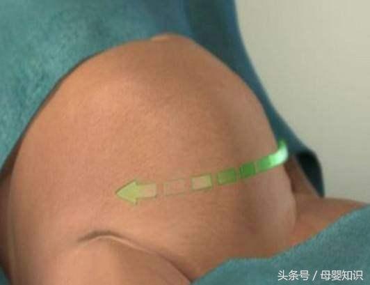 剖腹产疤痕误区,剖腹产常见的最基本的问题