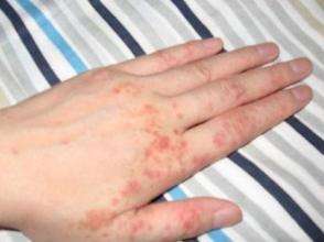 湿疹奇痒难忍怎么治疗,湿疹反复发作奇痒中医给两种方法