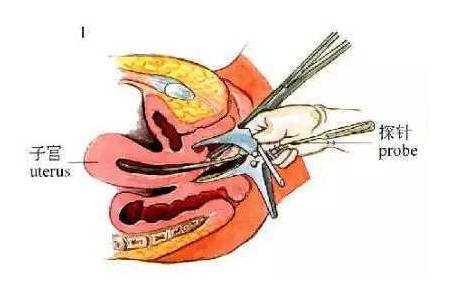 节育环取出关注些什么,女性节育环取环前关注事项