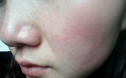 *血丝红**怎么治疗？教你7招祛除*血丝红**