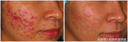 治疗疮疤中药,痔疮内服外用效果更好吗