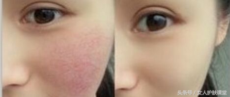 中药可以治好激素性皮炎吗,脂溢皮炎中药能治好吗