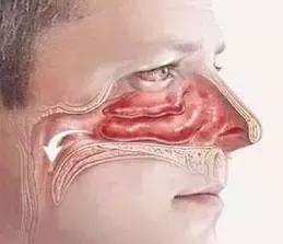 鼻炎久治不愈会变成鼻咽癌吗,90%鼻咽癌因鼻炎久治不愈所致