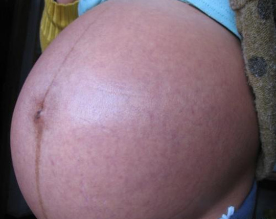 怀孕看肚子上的线准吗偏左偏右,怎么看妊娠线偏左还是偏右图片