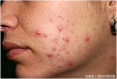 治疗疮疤中药,痔疮内服外用效果更好吗