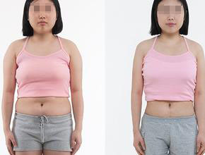 埋线减肥后怎样才能不反弹,埋线减肥肚子反而更大了