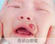 婴儿嘴角有血管瘤怎么办,血管瘤嘴上咬破了怎么办