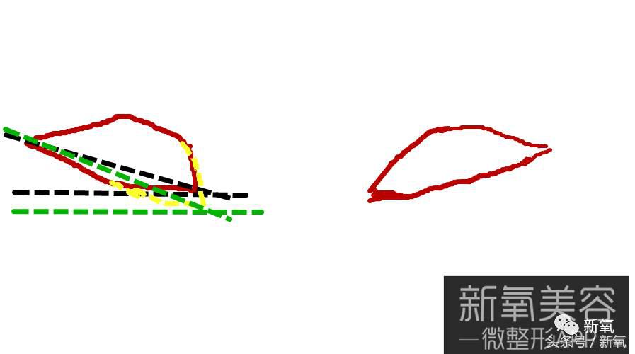 为什么开眼角会变漂亮,为什么开眼角很奇怪