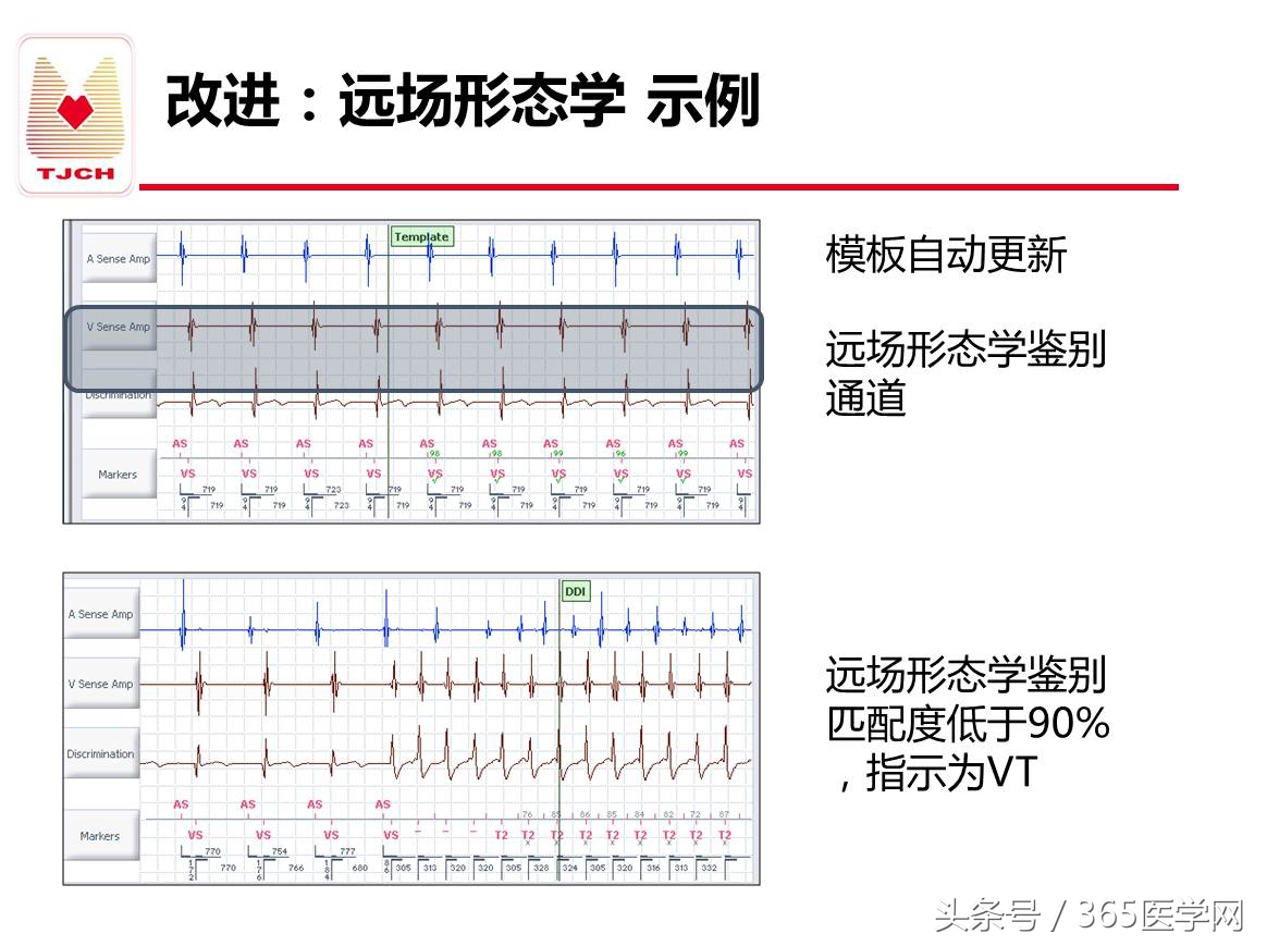 许静：新技术避免ICD不恰当放电