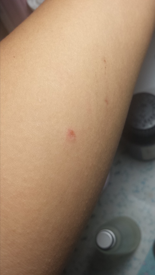 猫癣传染给人怎么治疗好得快,猫癣传染人好治吗