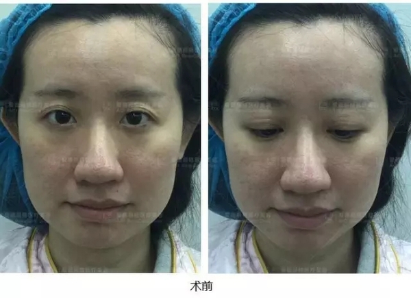 长期使用双眼皮胶水再去割双眼皮,长期用双眼皮胶水能变成永久性吗