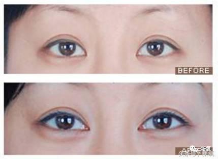 为什么开眼角会变漂亮,为什么开眼角很奇怪