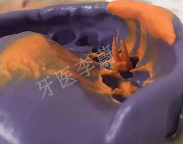 前牙残根桩冠修复,前磨牙嵌体修复