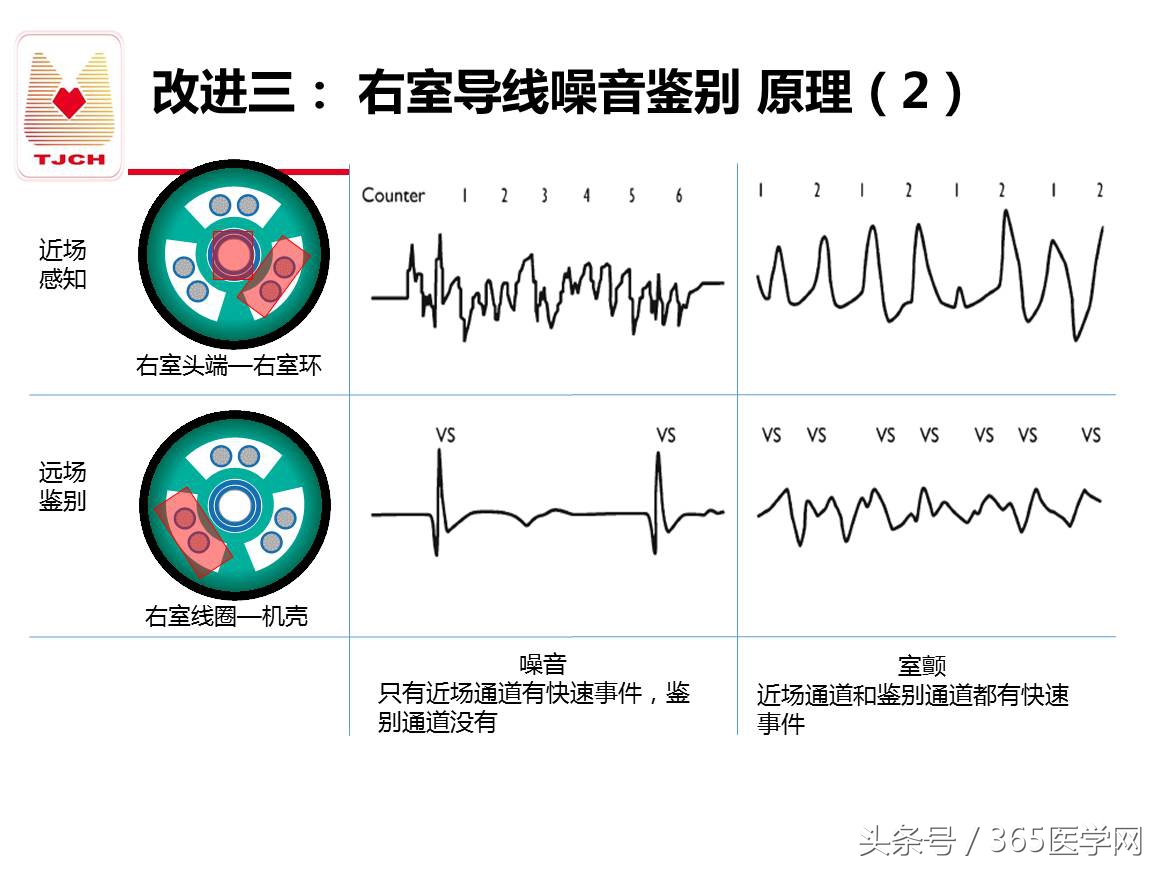 许静：新技术避免ICD不恰当放电