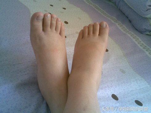 孕期妊娠反应最严重是什么态势,妊娠期的常见疾病识别及预防