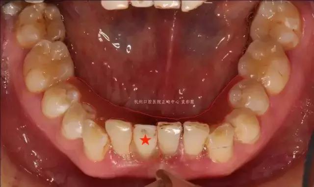 龅牙深覆合矫正效果,26岁了深覆合龅牙还能矫正吗