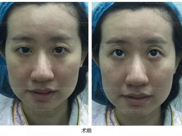 长期使用双眼皮胶水再去割双眼皮,长期用双眼皮胶水能变成永久性吗