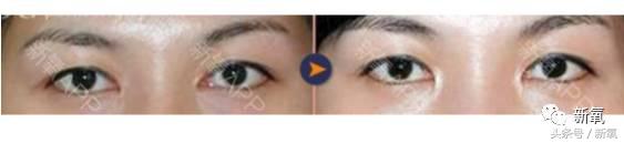 为什么开眼角会变漂亮,为什么开眼角很奇怪