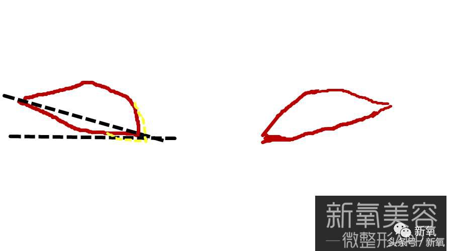 为什么开眼角会变漂亮,为什么开眼角很奇怪