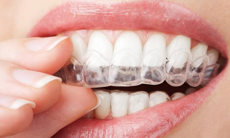 最新最安全有效的牙齿矫正方法,有一口好牙的重要性