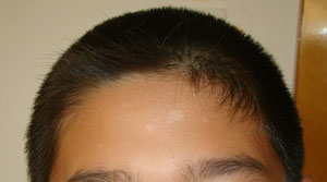 白斑治疗如何才能成功,老年性白斑治疗小妙招