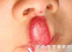 婴儿嘴角有血管瘤怎么办,血管瘤嘴上咬破了怎么办