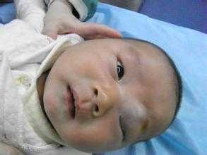 肝脏海绵状血管瘤怎么治疗,脑部海绵状血管瘤要不要紧