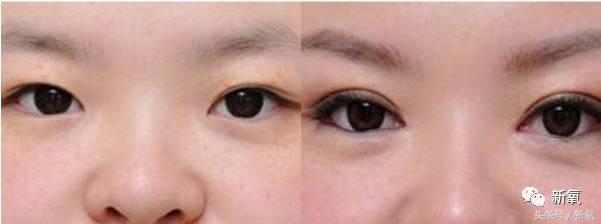 为什么开眼角会变漂亮,为什么开眼角很奇怪
