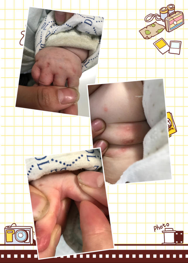 宝宝身上传染疥疮如何彻底根除,一岁宝宝传染疥疮怎么治