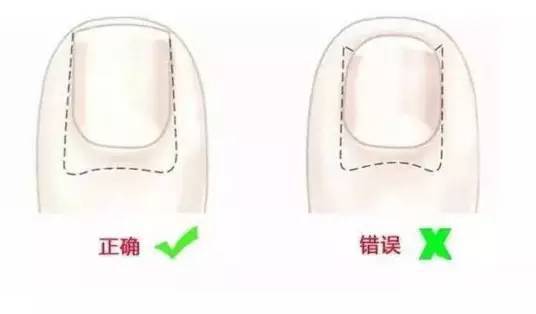 嵌甲，小病中的大智慧