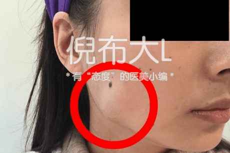 打完瘦脸针后如何维持瘦脸效果,打了瘦脸针脸上的肉会变多吗