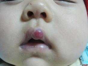 婴儿嘴角有血管瘤怎么办,血管瘤嘴上咬破了怎么办