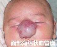 肝脏海绵状血管瘤怎么治疗,脑部海绵状血管瘤要不要紧