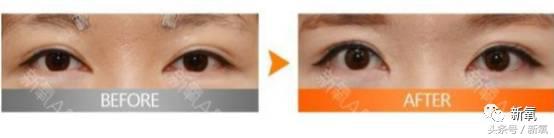 为什么开眼角会变漂亮,为什么开眼角很奇怪