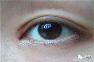 为什么开眼角会变漂亮,为什么开眼角很奇怪