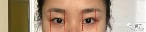 为什么开眼角会变漂亮,为什么开眼角很奇怪