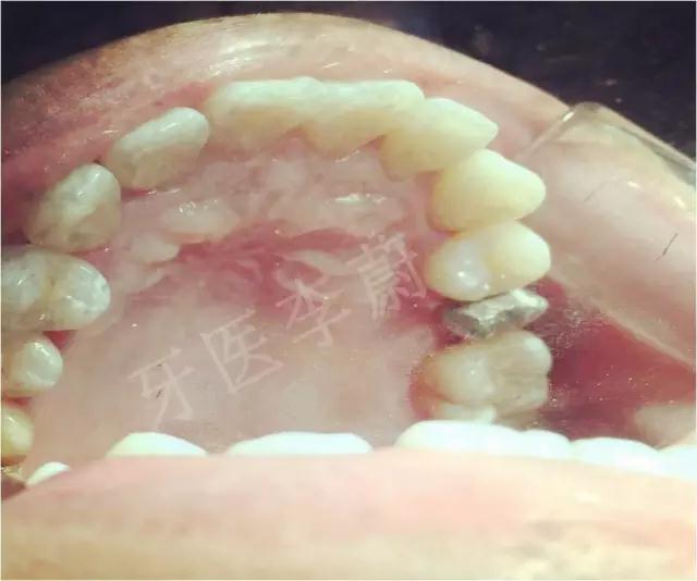 前牙残根桩冠修复,前磨牙嵌体修复