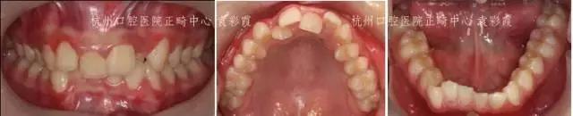 龅牙深覆合矫正效果,26岁了深覆合龅牙还能矫正吗