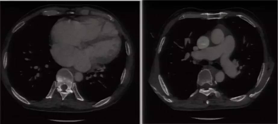 心脏增大引发的心衰能治好吗,急性心衰引起心脏扩大能治愈吗