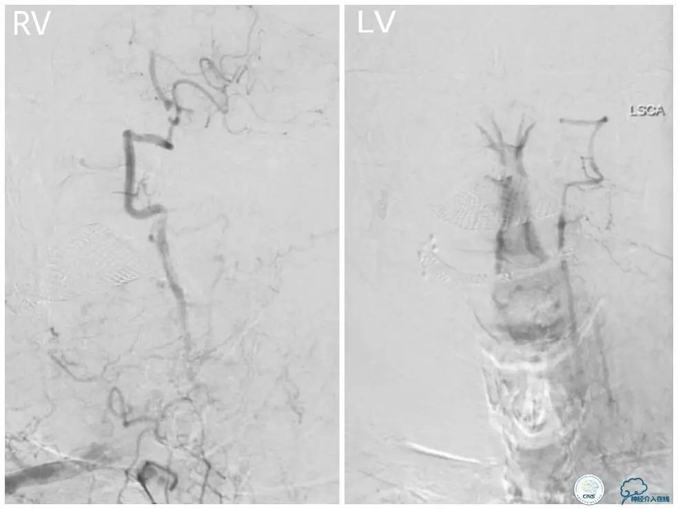 天坛周记｜右椎动脉V1段及V4-基底动脉串联病变支架治疗一例