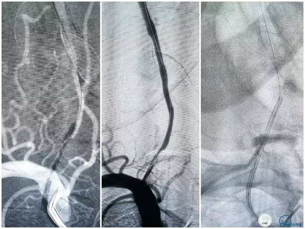 天坛周记｜右椎动脉V1段及V4-基底动脉串联病变支架治疗一例