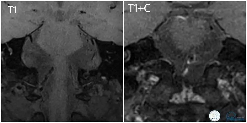 天坛周记｜右椎动脉V1段及V4-基底动脉串联病变支架治疗一例