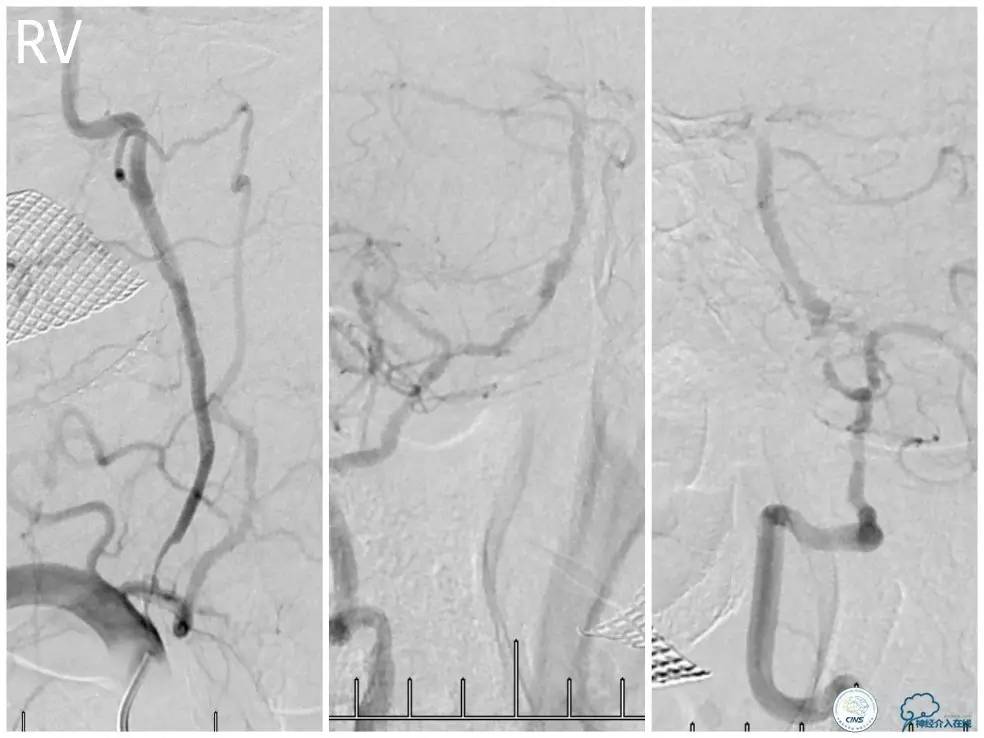 天坛周记｜右椎动脉V1段及V4-基底动脉串联病变支架治疗一例