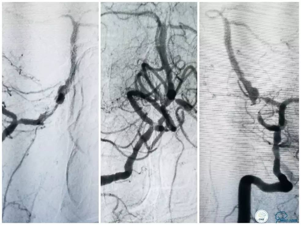 天坛周记｜右椎动脉V1段及V4-基底动脉串联病变支架治疗一例