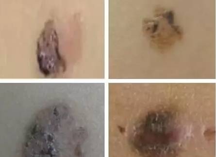 搓背把痣搓破了怎么办,洗澡搓破痣竟成癌