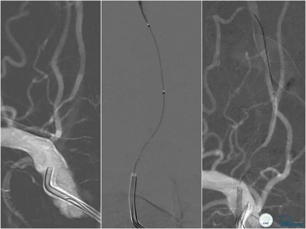 天坛周记｜右椎动脉V1段及V4-基底动脉串联病变支架治疗一例